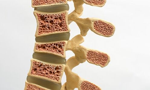 Osteoporosia bizkarreko minaren arrazoietako bat da