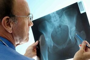 Hip juntaduraren artrosia x -Ray
