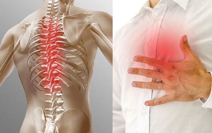 Osteokondrosia torakoa eta bularreko mina