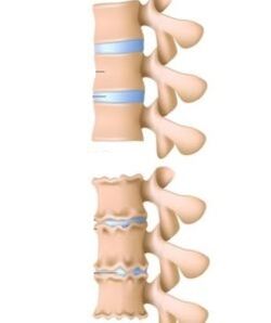 osteokondrosiaren arrazoiak